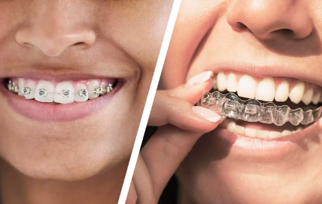 Compare Methods: Which Orthodontic Options Offer Seamless Teeth Straightening?
