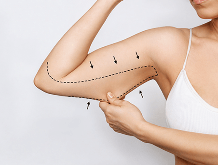 What to Know Before Considering Upper-Arm Contouring